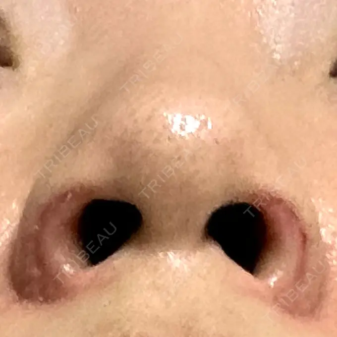 鼻孔縁挙上 シエルクリニック DAY 12 メイン用