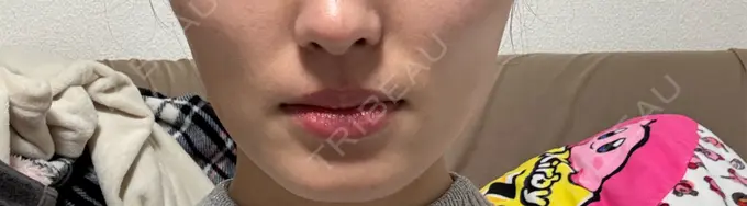 ボトックス（あご） / ボトックス（エラ・小顔） / ボトックス（眉間） 新宿TAクリニック AFTER メイン用