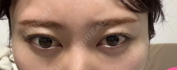 ボトックス（あご） / ボトックス（エラ・小顔） / ボトックス（眉間） 新宿TAクリニック DAY 2 メイン用