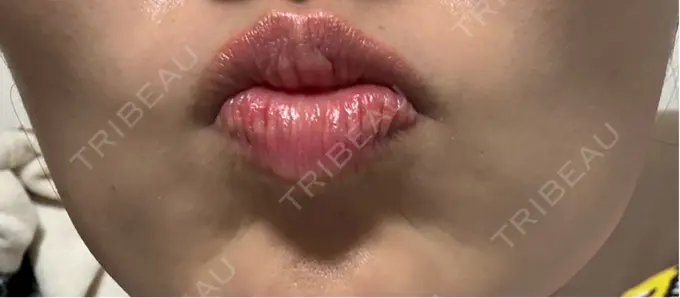 ボトックス（あご） / ボトックス（エラ・小顔） / ボトックス（眉間） 新宿TAクリニック DAY 2 メイン用