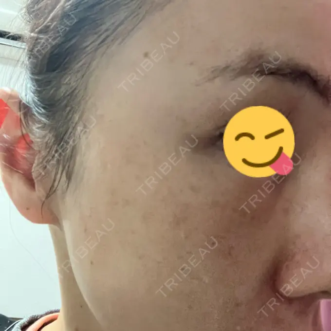 ボトックス（目尻） 東京美容医療クリニック 池袋院 DAY 2 メイン用