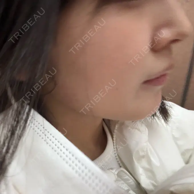 ボトックス（あご） / ボトックス（エラ・小顔） アールクリニック AFTER メイン用