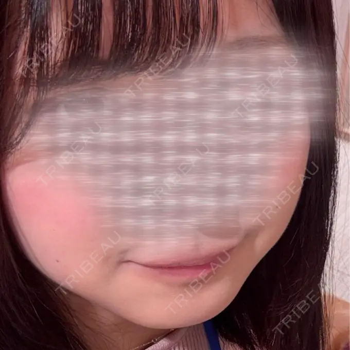 ボトックス（あご） / ボトックス（エラ・小顔） アールクリニック DAY 16 メイン用