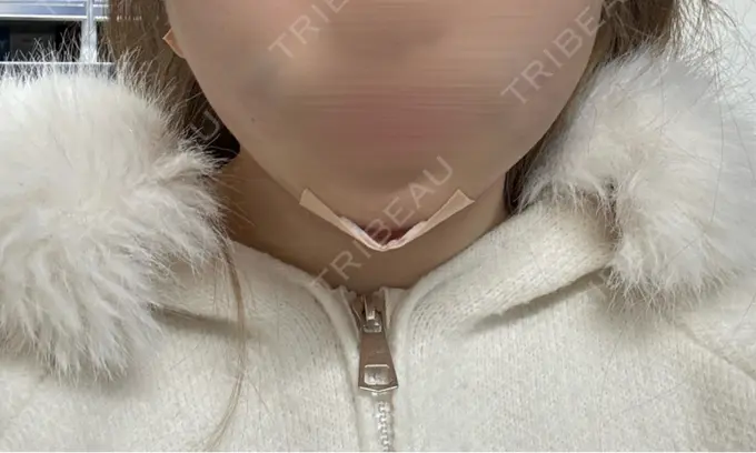 糸リフト / 脂肪吸引（顔） 東京ココセランクリニック DAY 0 メイン用