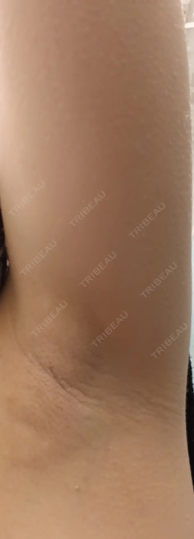 ワキ汗治療（レーザー） フォンタナクリニック天神 DAY 9 メイン用