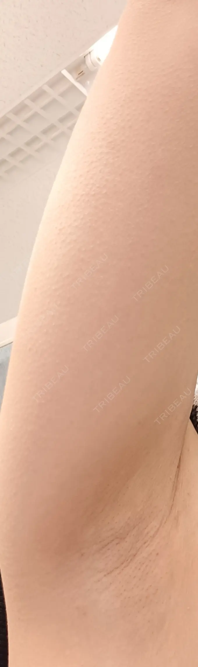 ワキ汗治療（レーザー） フォンタナクリニック天神 DAY 9 メイン用