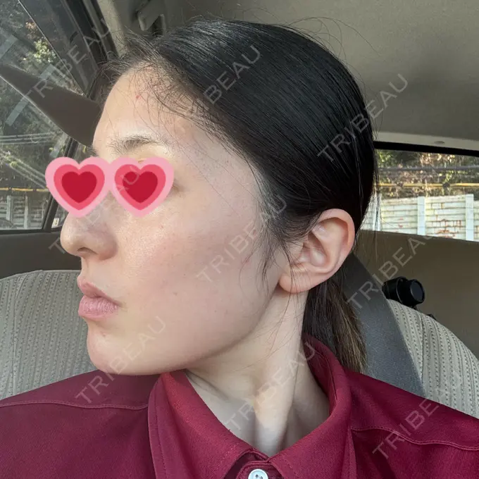 ボトックス（エラ・小顔） REDLINE CLINIC DAY 4 メイン用