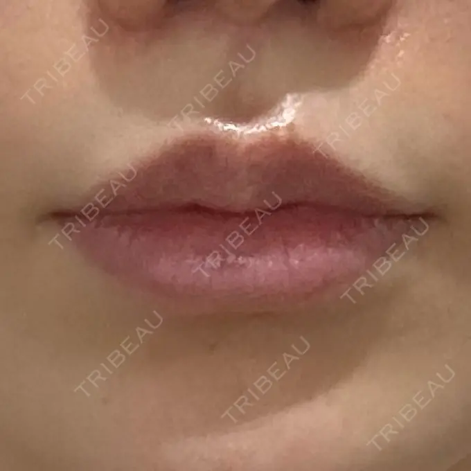 人中短縮 eクリニック 大阪梅田 西日本統括院 AFTER メイン用