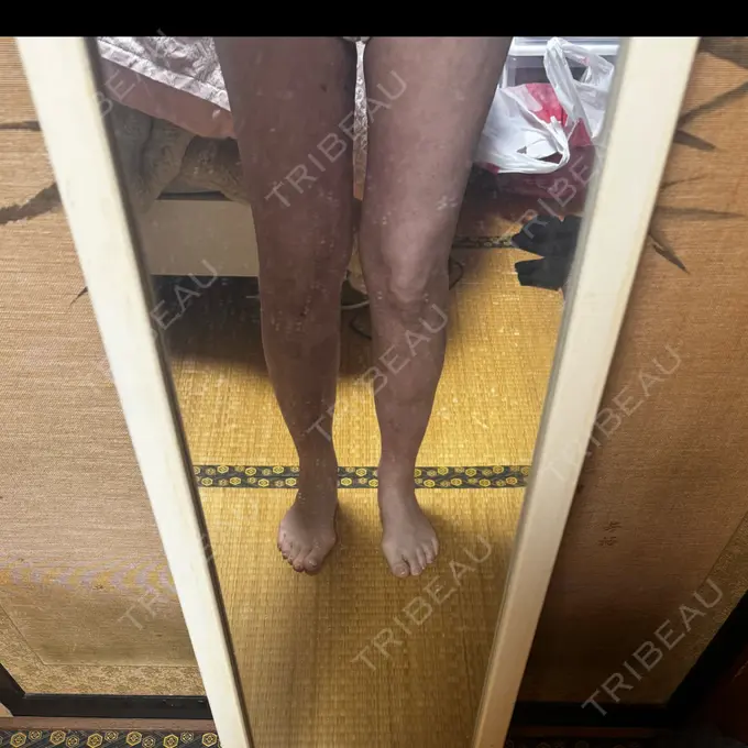 脂肪溶解注射（太もも） HAAB×DREAM BEAUTY CLINIC 東京本院 AFTER メイン用