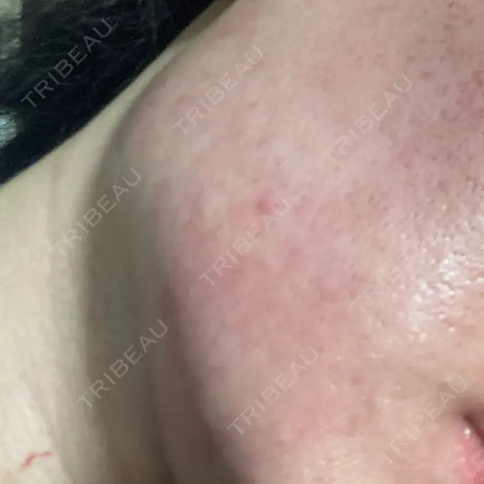 医療脱毛（顔） ZX-CLINIC AFTER メイン用