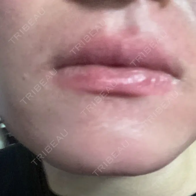 医療脱毛（顔） ZX-CLINIC DAY 1 メイン用