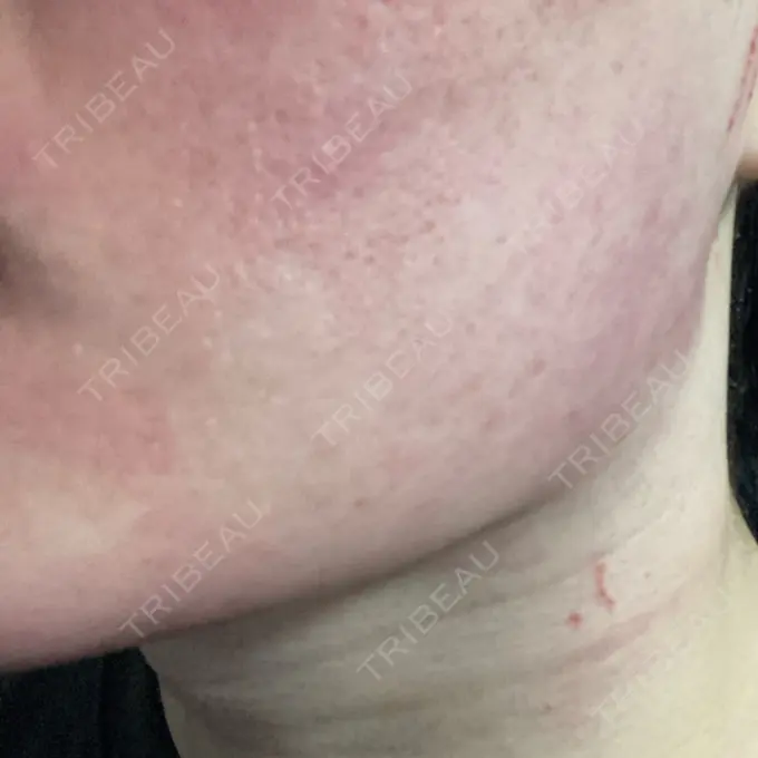 医療脱毛（顔） ZX-CLINIC DAY 1 メイン用