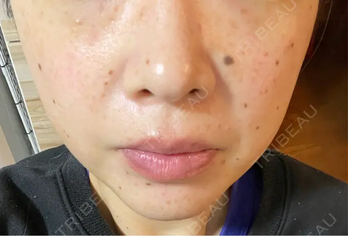 イオン導入 ルラ美容クリニック 千葉院 / ルラスキンクリニック 千葉院 AFTER メイン用