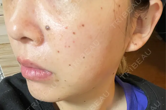 イオン導入 ルラ美容クリニック 千葉院 / ルラスキンクリニック 千葉院 DAY 1 メイン用