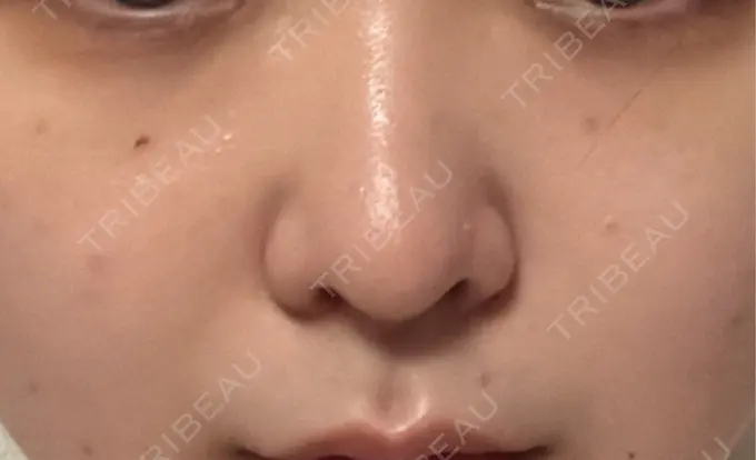 ヒアルロン酸注入（鼻翼基部） THE FIRST CLINIC 町田院 DAY 0 メイン用