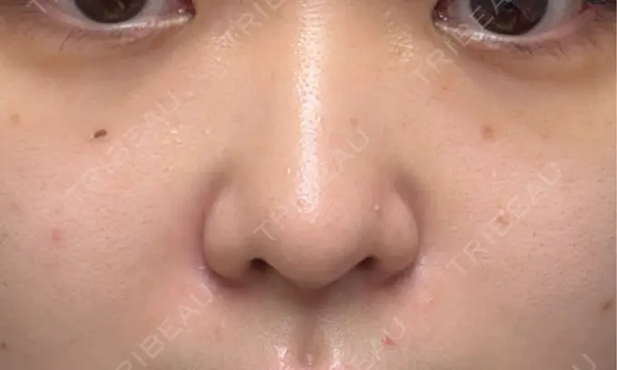 ヒアルロン酸注入（鼻翼基部） THE FIRST CLINIC 町田院 AFTER メイン用