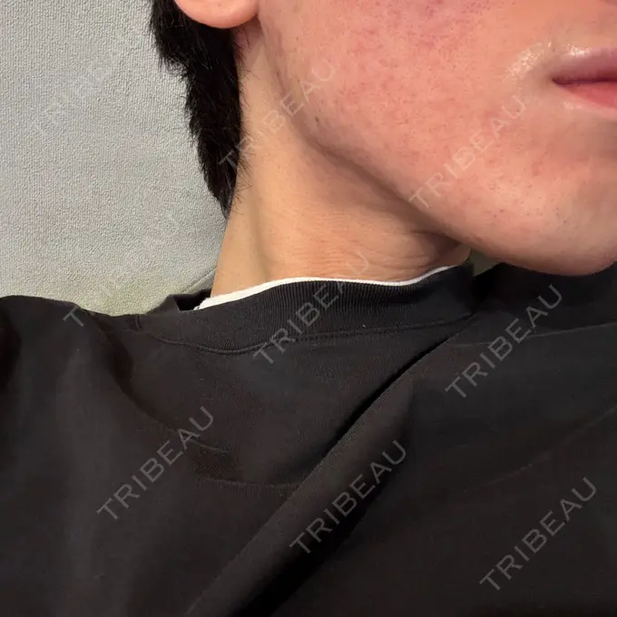 ボトックス（エラ・小顔） DMTC CLINIC 日本橋院 DAY 11 メイン用