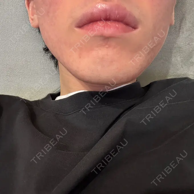 ボトックス（エラ・小顔） DMTC CLINIC 日本橋院 DAY 11 メイン用