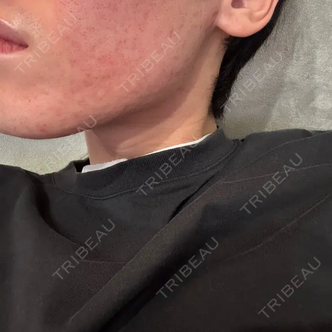 ボトックス（エラ・小顔） DMTC CLINIC 日本橋院 DAY 11 メイン用