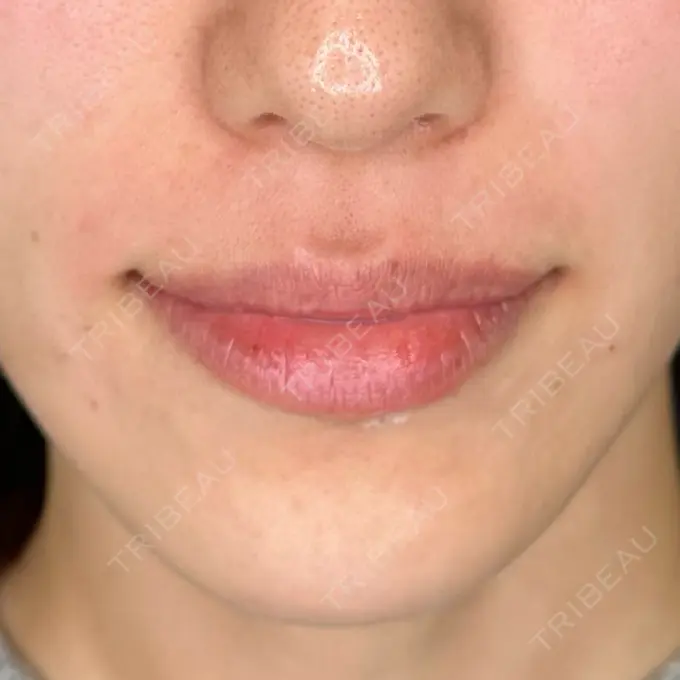 肌ヒアルロン酸注入（たるみ・シワ改善） / イオン導入 / ルメッカ ルラ美容クリニック 静岡院 AFTER メイン用