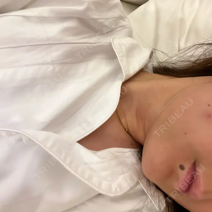 ハイフ（顔） GRACY TOKYO CLINIC【グレイシートウキョウクリニック】 DAY 0 メイン用