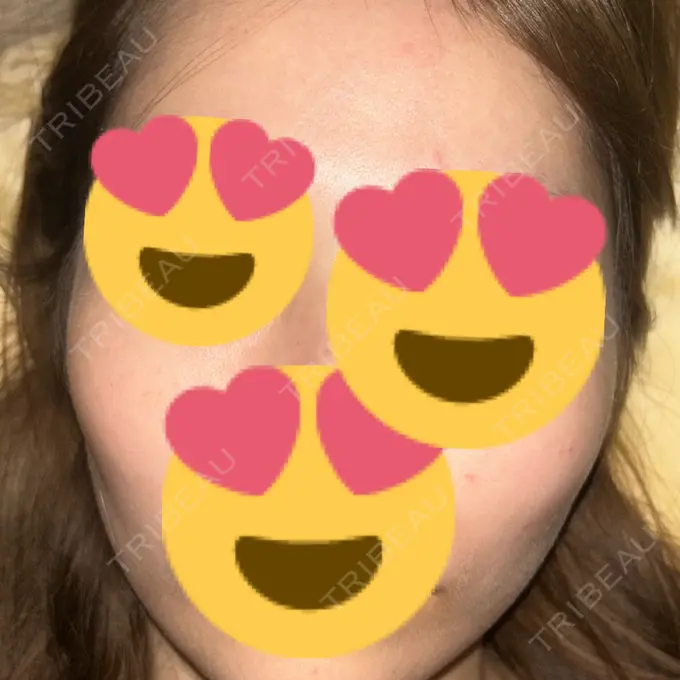 ほくろ・いぼ除去レーザー（肌） 共立美容外科 名古屋院 DAY 11 メイン用