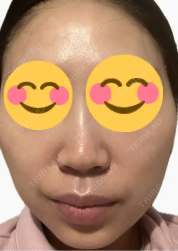 プラセンタ注射 美容皮膚科エルムクリニック 麻布院 DAY 1 メイン用