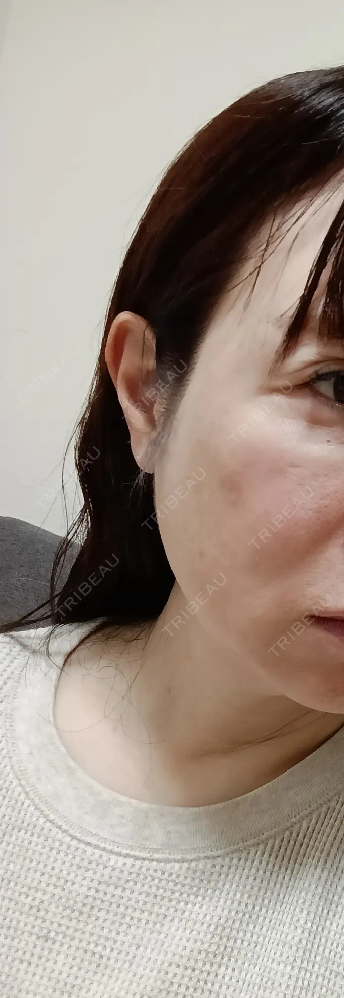 ヒアルロン酸注入（こめかみ） AZ BEAUTY CLINIC AFTER メイン用