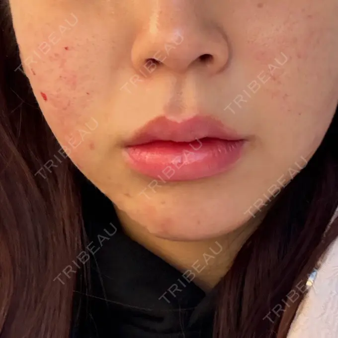 肌育注射（ジュベルックなど） Natural Skin Clinic 笹塚院 DAY 0 メイン用