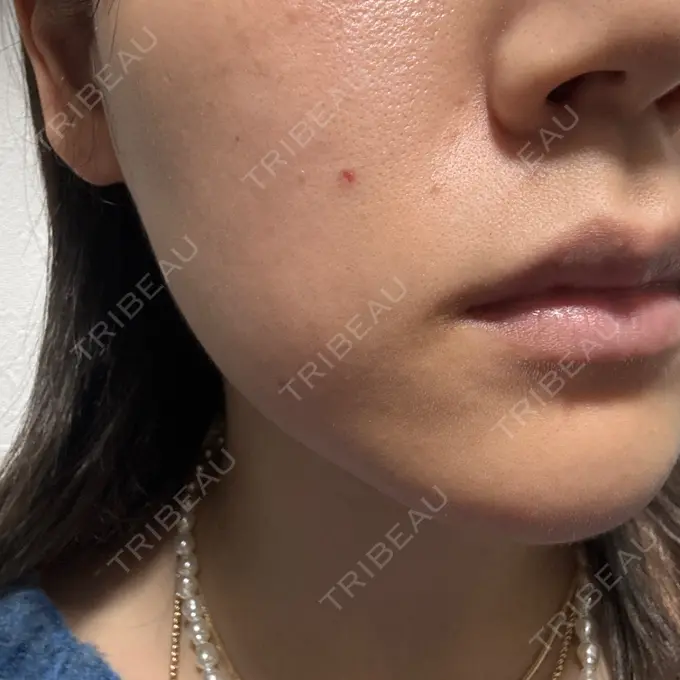 ほくろ・いぼ除去レーザー（肌） / シミ取りレーザー 東京シルククリニック 新宿院 DAY 20 メイン用