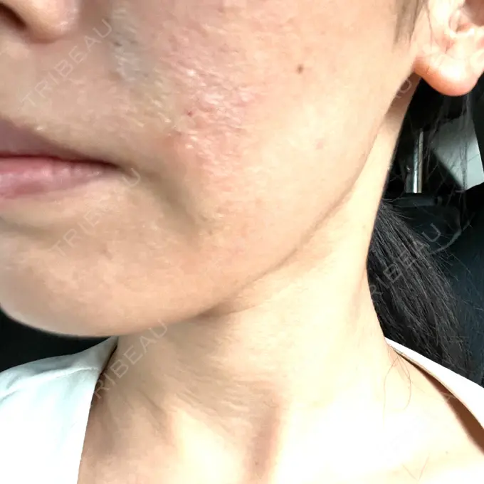 ショッピングリフト Natural Skin Clinic 笹塚院 AFTER メイン用