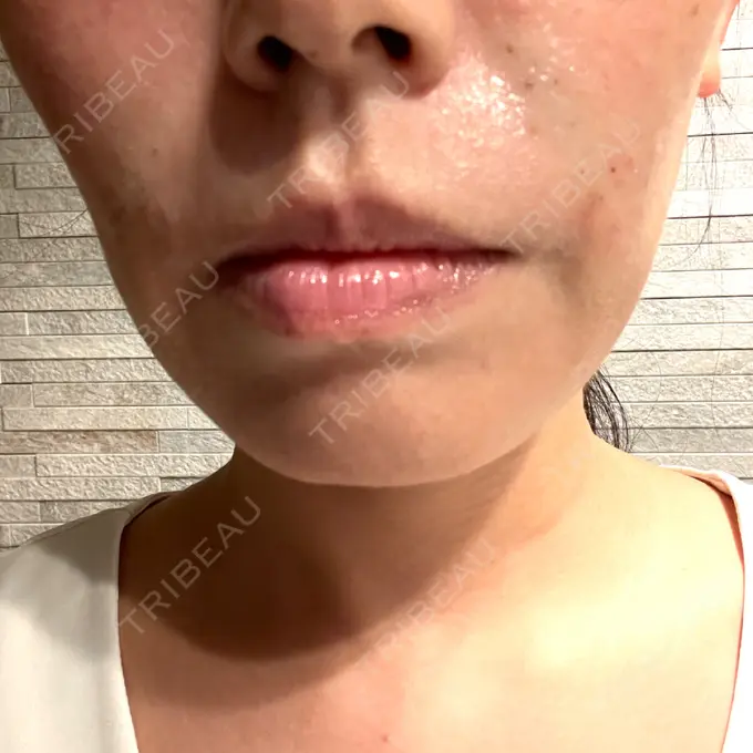 ショッピングリフト Natural Skin Clinic 笹塚院 DAY 22 メイン用