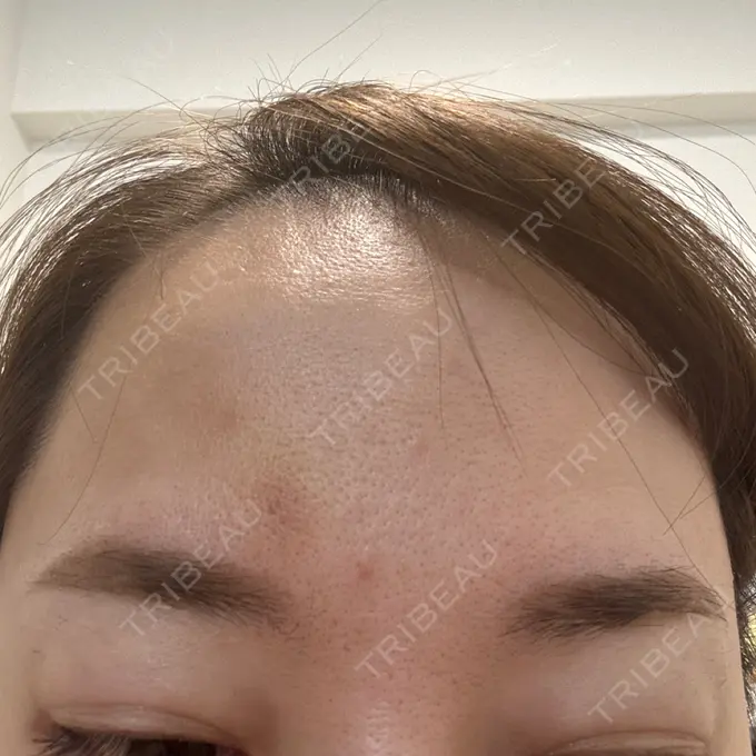 ボトックス（眉間） TCB東京中央美容外科 千葉駅前院 AFTER メイン用