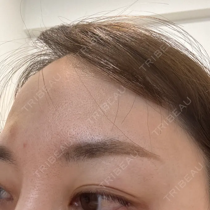 ボトックス（眉間） TCB東京中央美容外科 千葉駅前院 DAY 9 メイン用