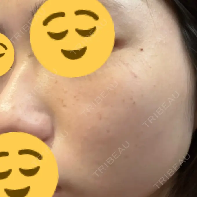 光治療（フォトフェイシャルなど） 東京美容外科 福山院 DAY 0 メイン用