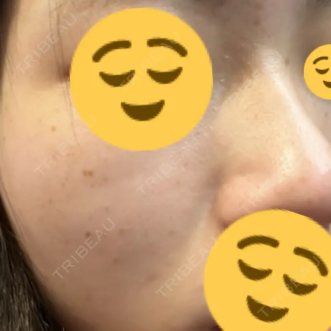 光治療（フォトフェイシャルなど） 東京美容外科 福山院 DAY 0 メイン用