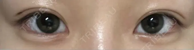 二重埋没 恵聖会クリニック 京橋院 AFTER メイン用