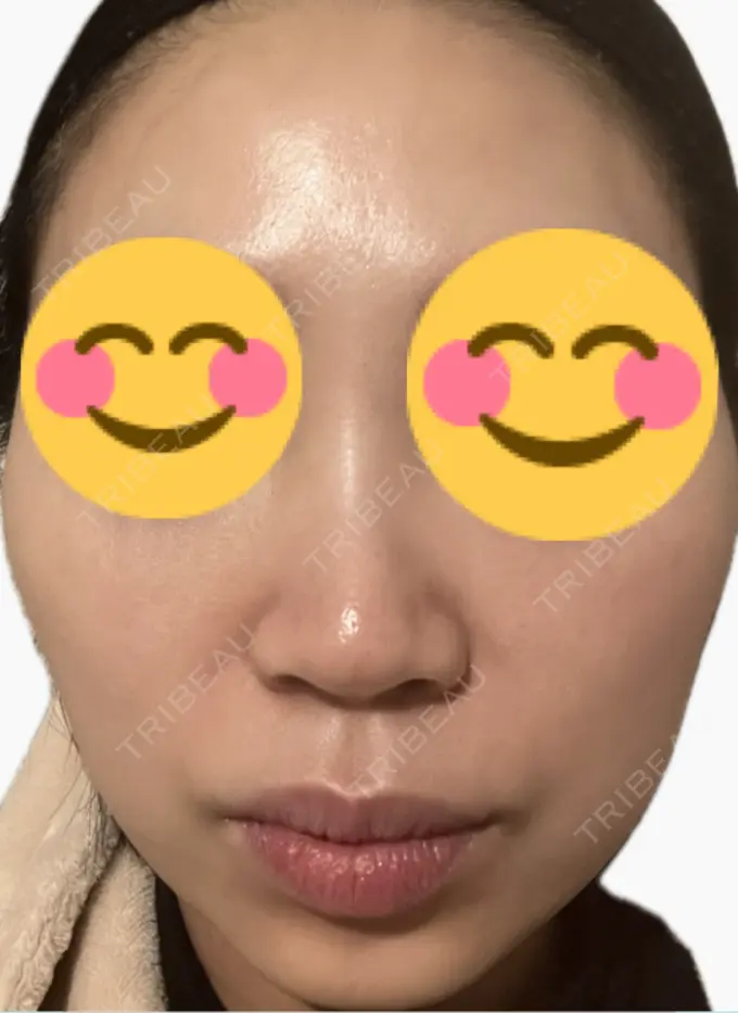 プラセンタ注射 美容皮膚科エルムクリニック 麻布院 DAY 2 メイン用