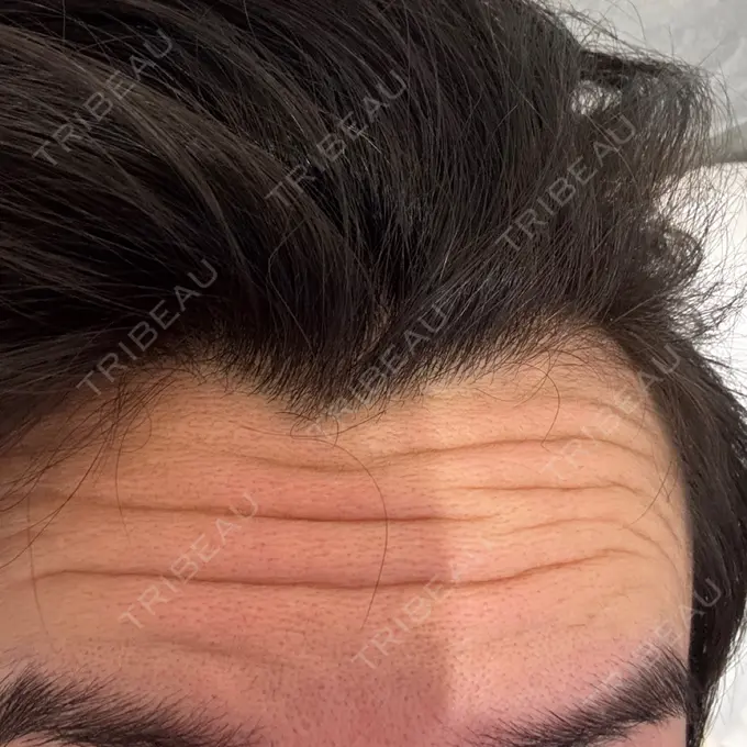 ボトックス（額） DMTC CLINIC 日本橋院 DAY 0 メイン用