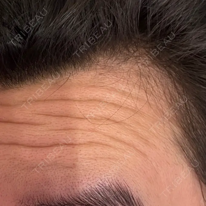 ボトックス（額） DMTC CLINIC 日本橋院 DAY 0 メイン用