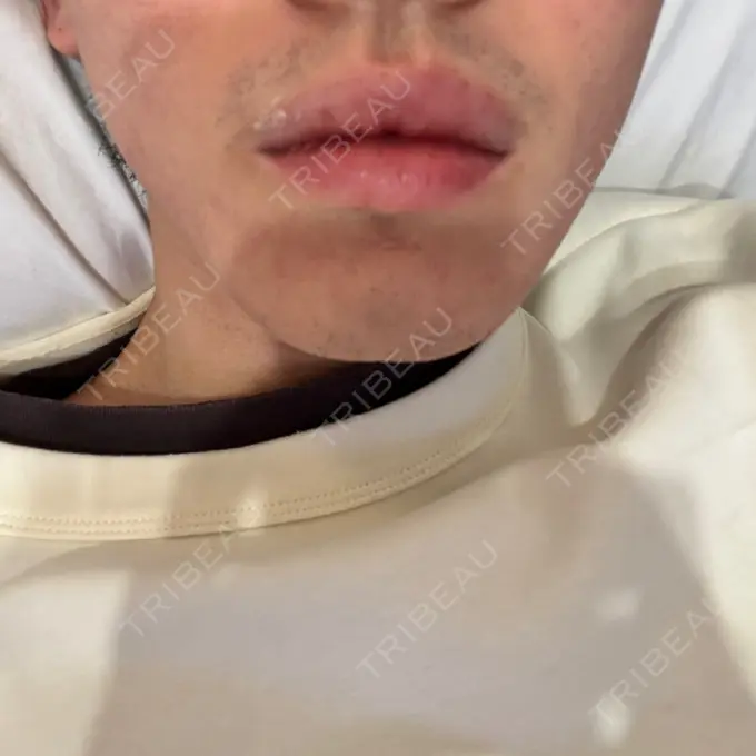 ボトックス（エラ・小顔） DMTC CLINIC 日本橋院 DAY 12 メイン用