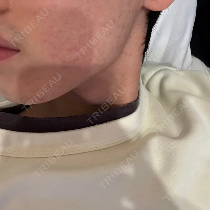 ボトックス（エラ・小顔） DMTC CLINIC 日本橋院 DAY 12 メイン用