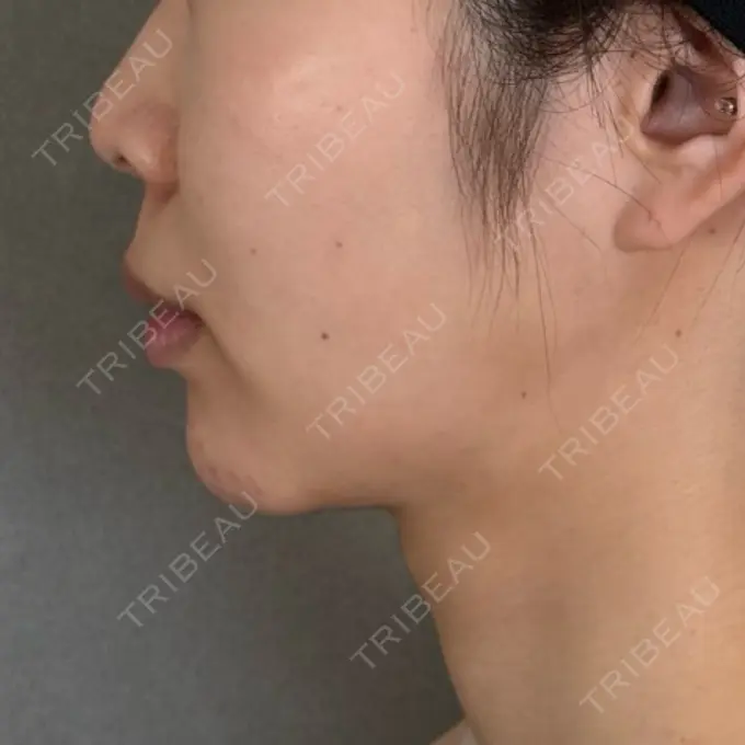 脂肪吸引（顔） / ジョールファット除去 / ボトックス（エラ・小顔） アリエル美容クリニック 大宮院 AFTER メイン用