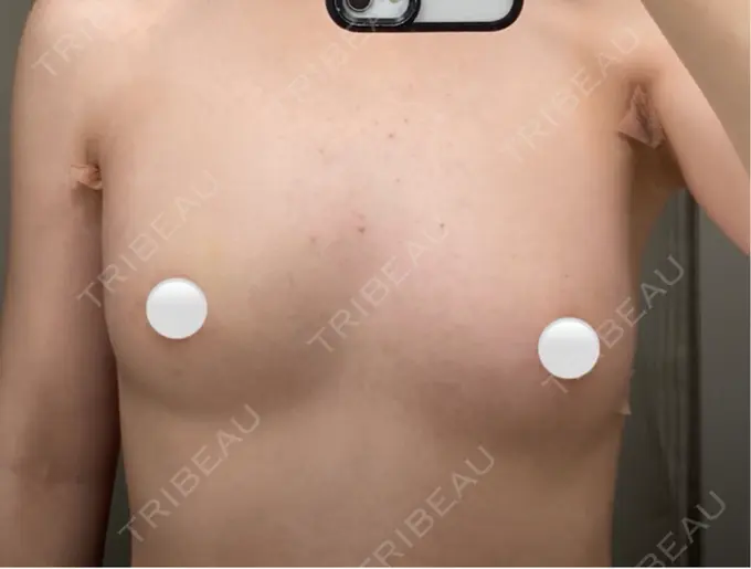 豊胸（脂肪注入） ルーチェクリニック 銀座院 DAY 21 メイン用