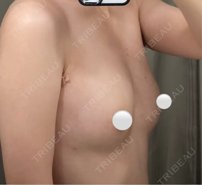 豊胸（脂肪注入） ルーチェクリニック 銀座院 DAY 21 メイン用