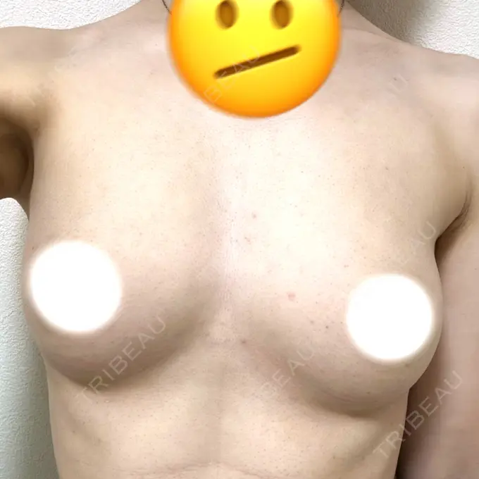 豊胸（脂肪注入） Bloom Delight Clinic AFTER メイン用