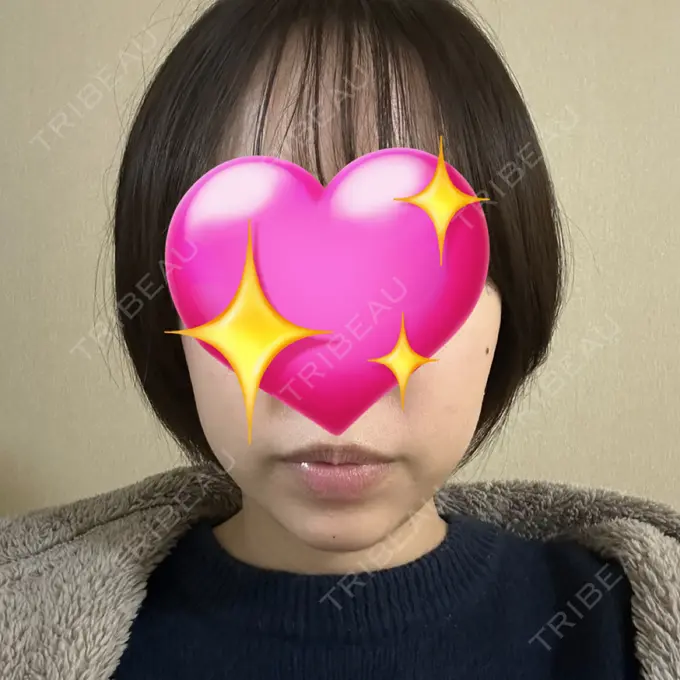 ヒアルロン酸注入（あご） Otus Clinic 【オータスクリニック】 DAY 0 メイン用