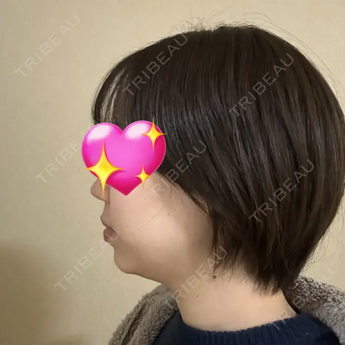 ヒアルロン酸注入（あご） Otus Clinic 【オータスクリニック】 DAY 0 メイン用