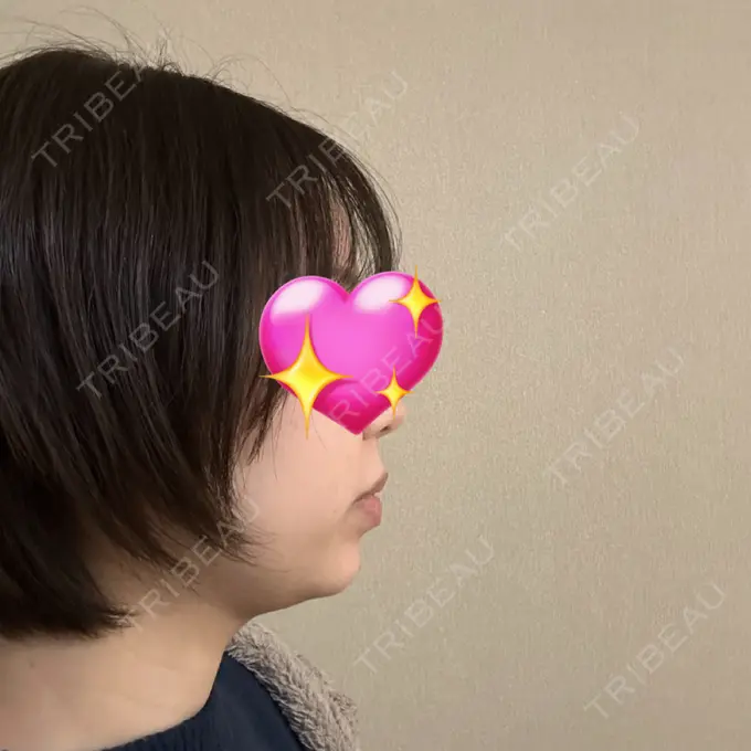 ヒアルロン酸注入（あご） Otus Clinic 【オータスクリニック】 DAY 0 メイン用