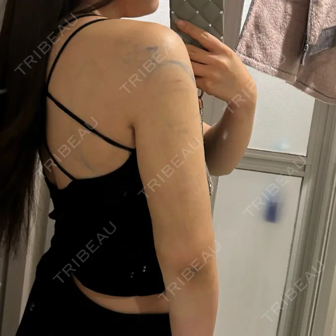 脂肪吸引（顔） / 脂肪吸引（二の腕） / ジョールファット除去 / 脂肪吸引（肩） 湘南美容クリニック Regno 銀座院 DAY 3 メイン用